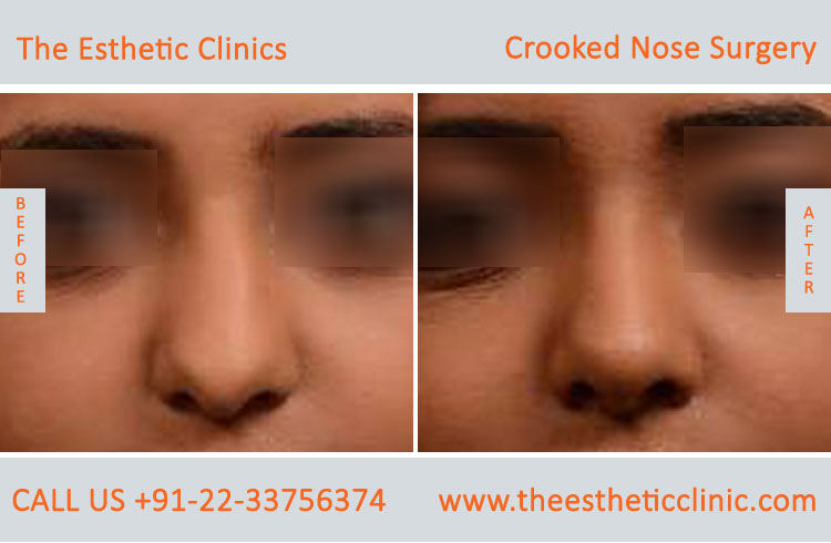 Crooked Nose Surgery before after photos in mumbai india (1)
